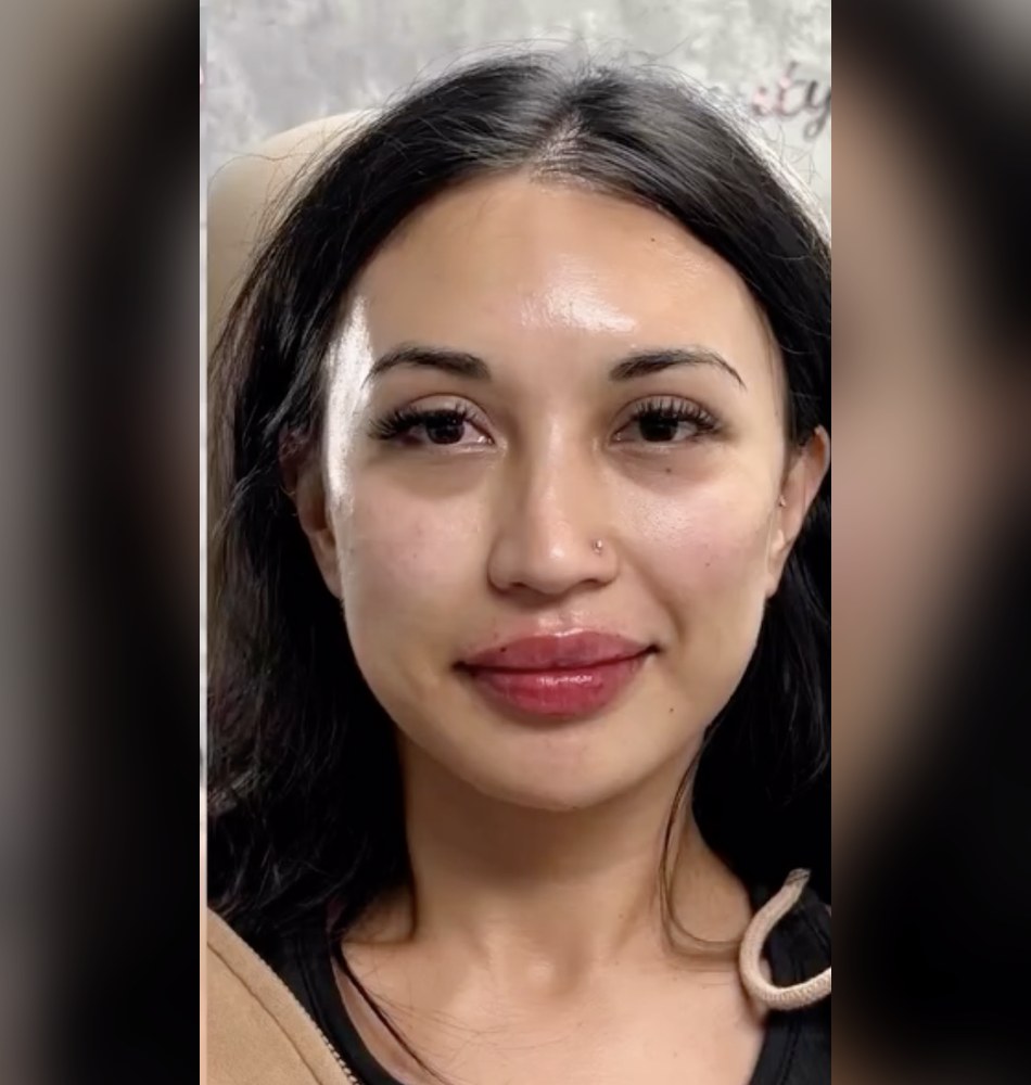 After: immediately post HA filler for full facial balancing