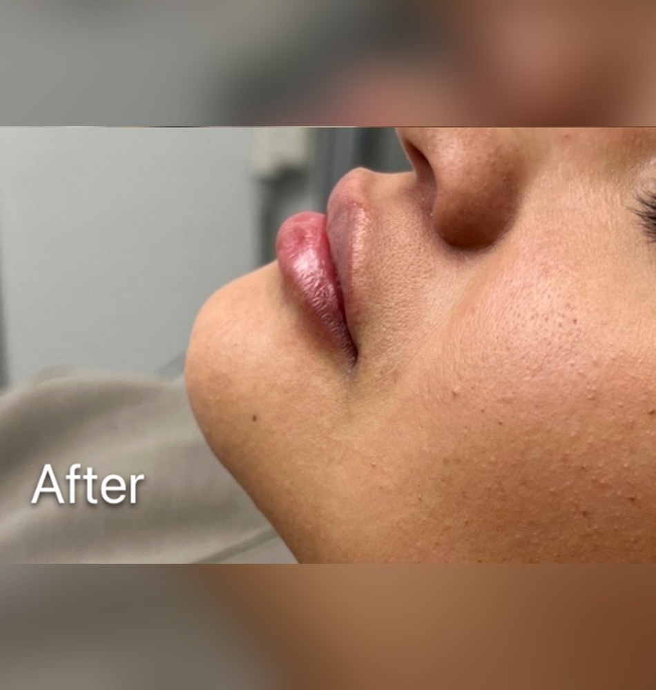 After: immediately post subtle lip enhancement with HA filler