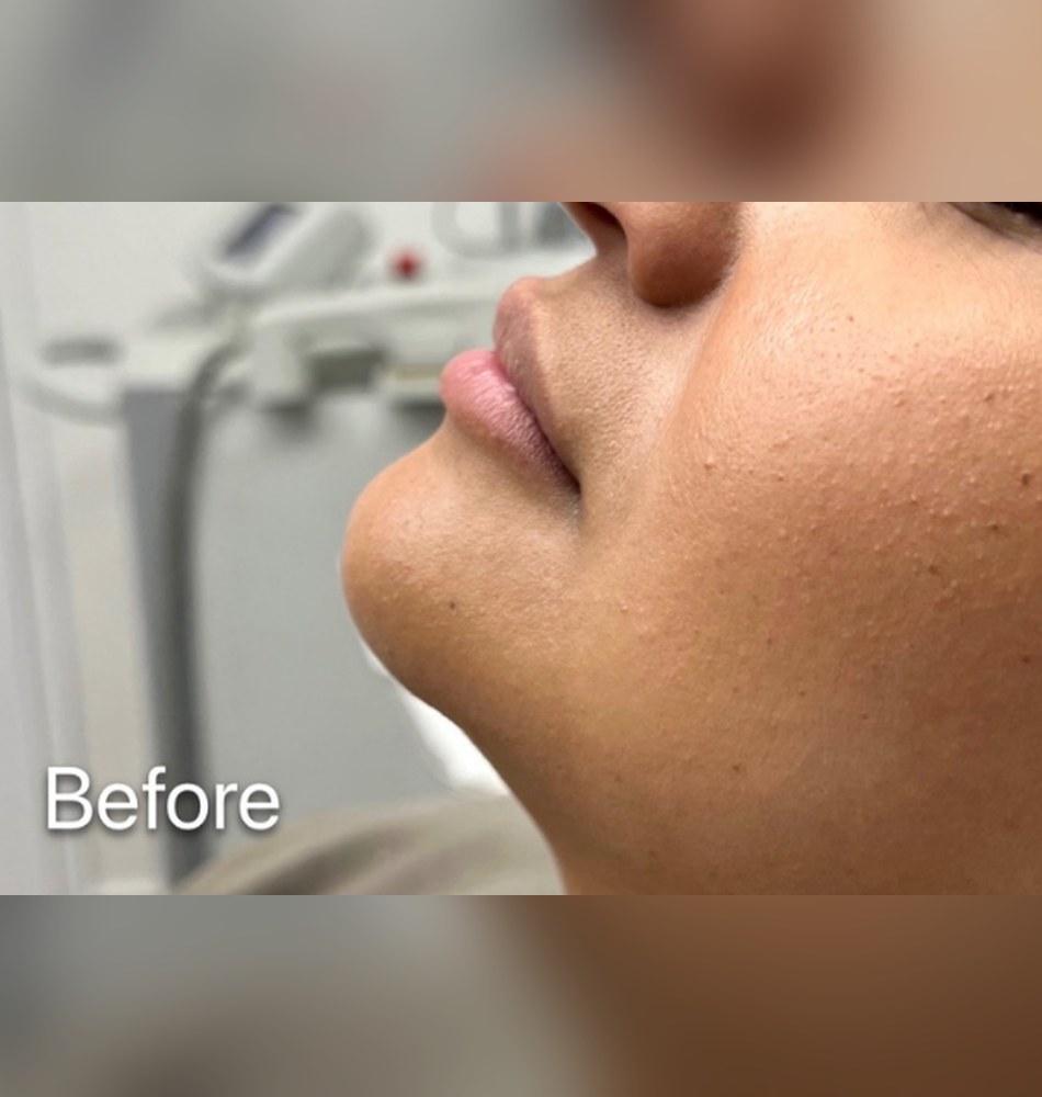 Before subtle lip enhancement with HA filler