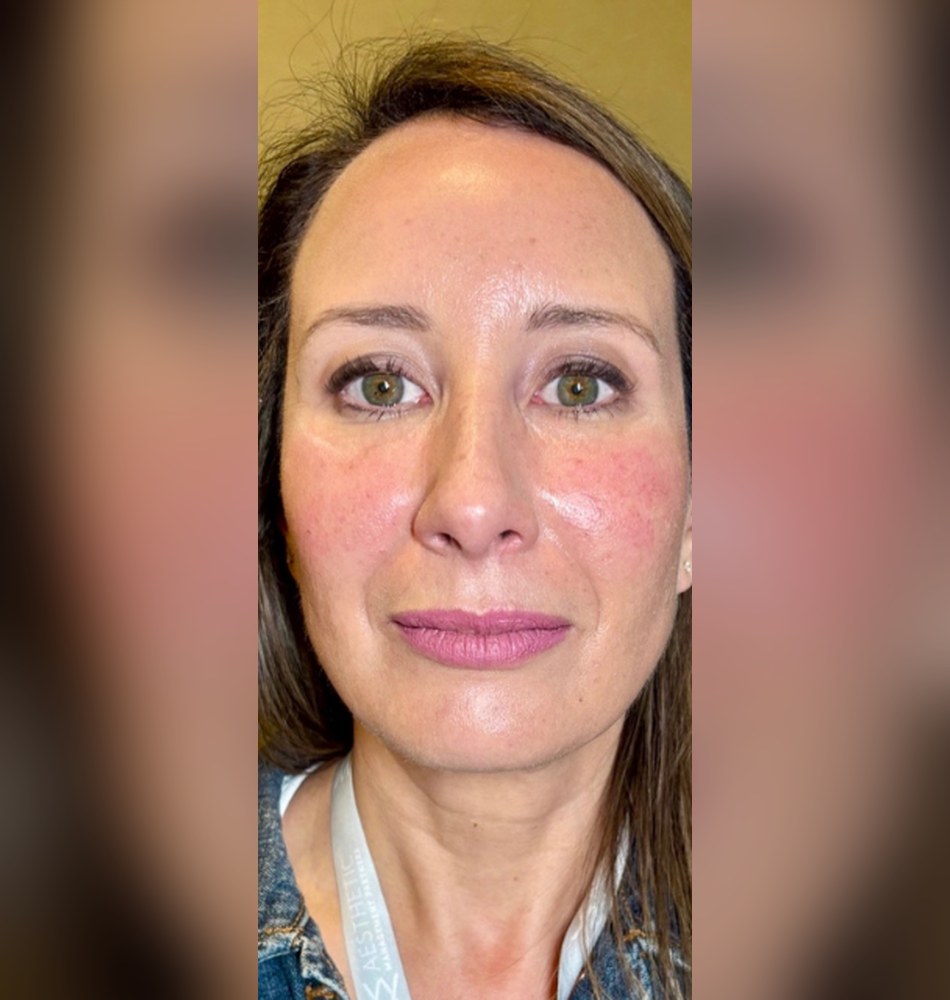 After: immediately post PRP biofiller to the undereyes and midface