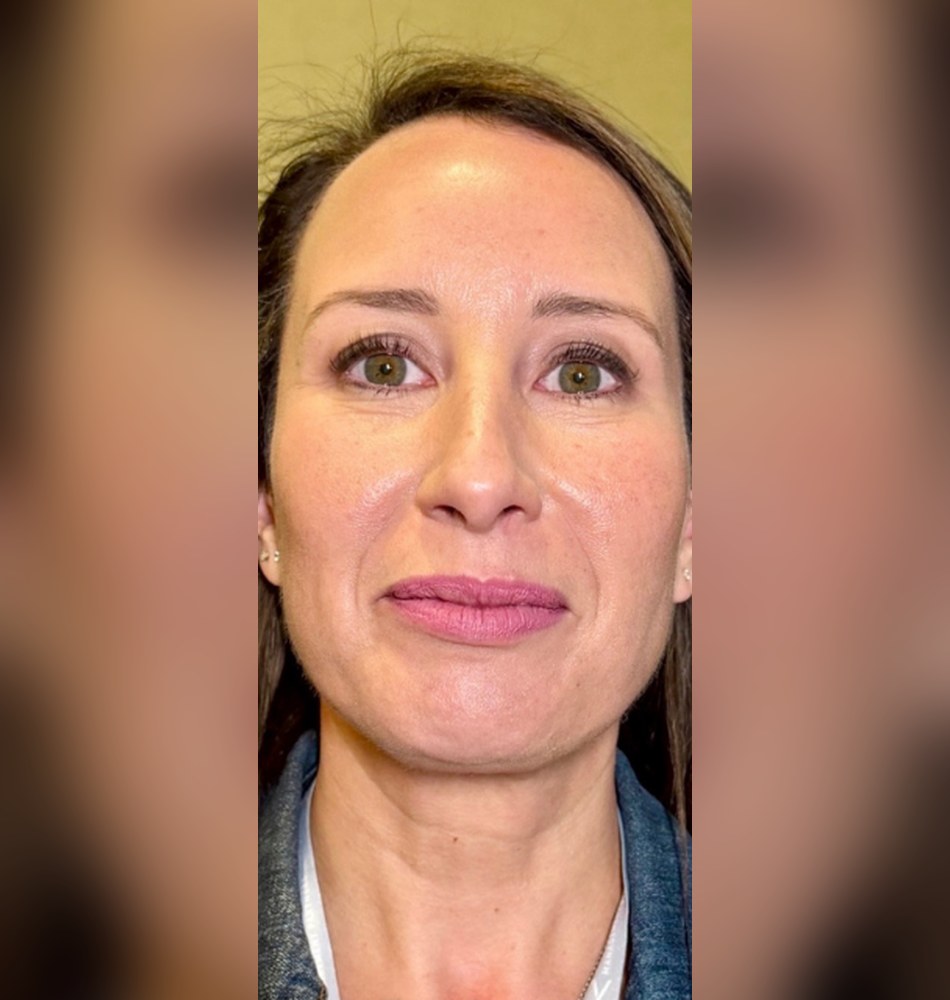 Before PRP biofiller to the undereyes and midface
