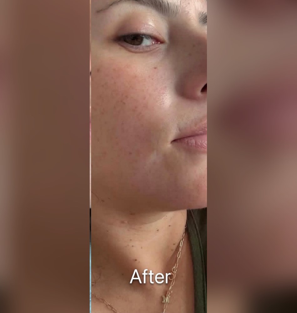 After: six months of consistent at-home skincare with the ZO Skin Health anti-aging kit