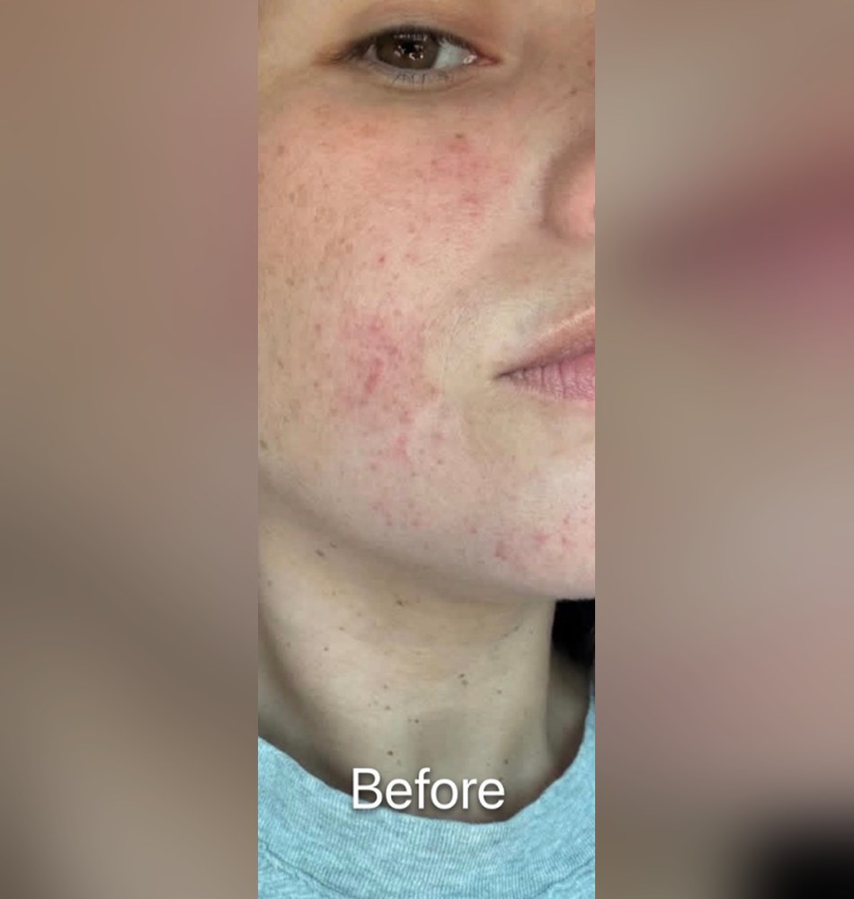 Before starting at-home skincare with the ZO Skin Health anti-aging kit