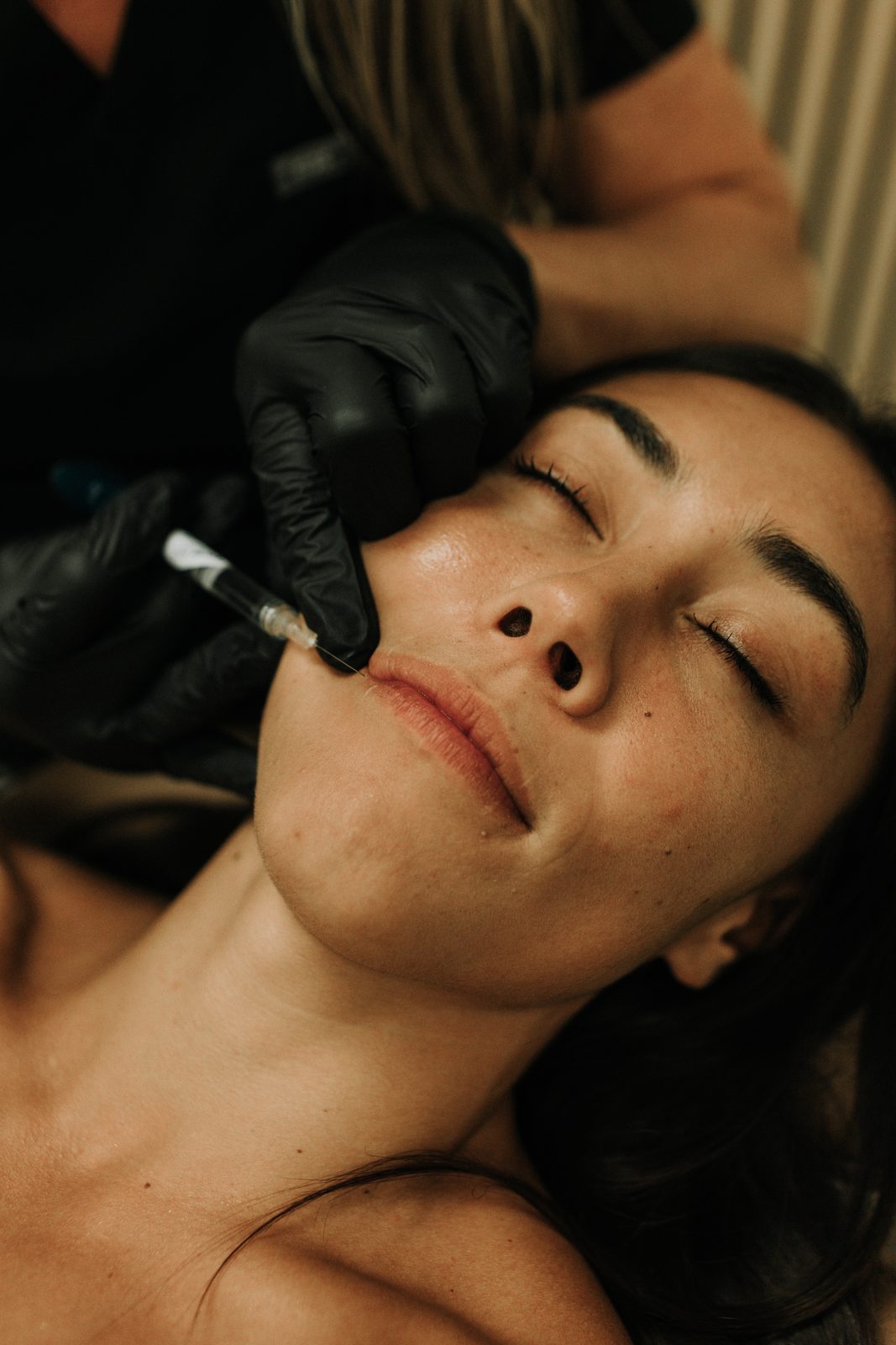 A hyaluronic acid filler injection at the corner of a client's lips at FloState